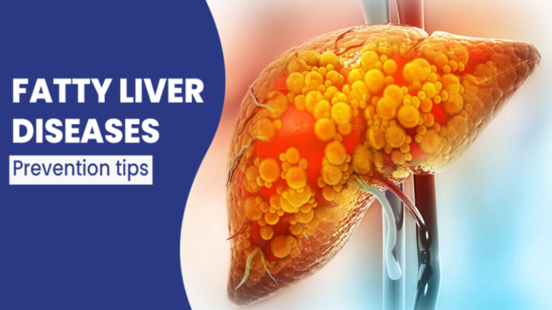 FATTY-LIVER-DISEASES